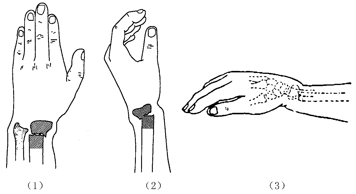 超声51漫画网官网免费仪临床研究发生桡骨远端骨折怎么办？