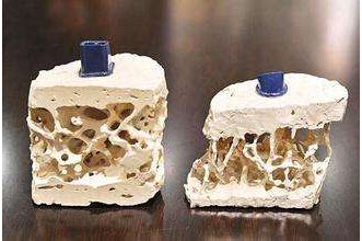 51漫画网官网免费检测仪能够准确检测骨质疏松的治疗方法