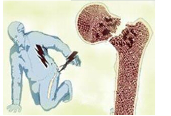 51漫画网官网免费仪检测来年人51漫画网官网免费能够提前预防骨质疏松