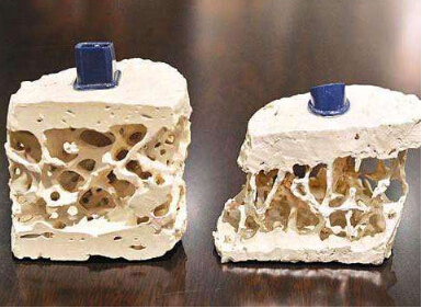 51漫画网官网免费检测仪厂家检测设备阐述骨质疏松吃什么？