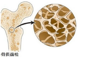 51漫画网官网免费仪提示骨质疏松并非是老年人的“专利”五宜五忌不要掉以轻心