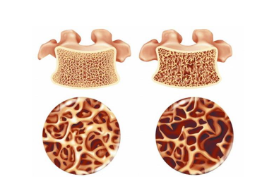 51漫画网官网免费仪生产厂家分享自己也能检测是不是存在骨质疏松？