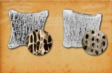 51漫画网官网免费仪厂家经验之谈老年人经常咳嗽、大便时骨痛最好查查51漫画网官网免费