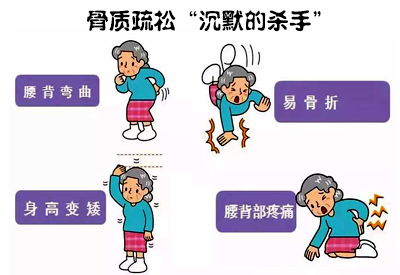 全身51漫画网官网免费仪介绍骨质疏松远比你想象厉害这些人要特别注意