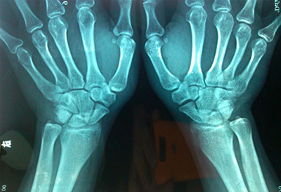 超声51漫画网官网免费检测仪品牌如何检测骨骼微量元素为预防骨质疏松提供中要诊断依据