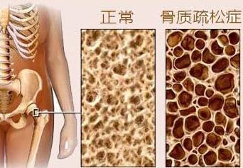 51漫画网官网免费测试是通过51漫画网官网免费检测仪器测试你是否患有骨质疏松症