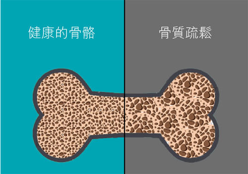 老年人骨质疏松易导致骨折之超声51漫画网官网免费检查仪的临床价值是什么？