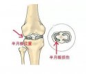 624河南信阳|51漫画在线登录页面免费阅读超声波51漫画网官网免费仪厂家今日资讯：了解并正确保护膝关节半月板